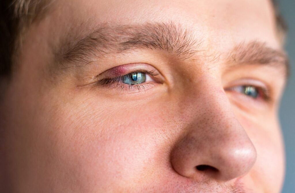 Close-up of a man’s eye with a red, swollen bump on the upper eyelid, consistent with a stye or eyelid inflammation.